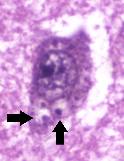 File:Histopathology of granulovacuolar degeneration in Alzheimer's disease - annotated.jpg