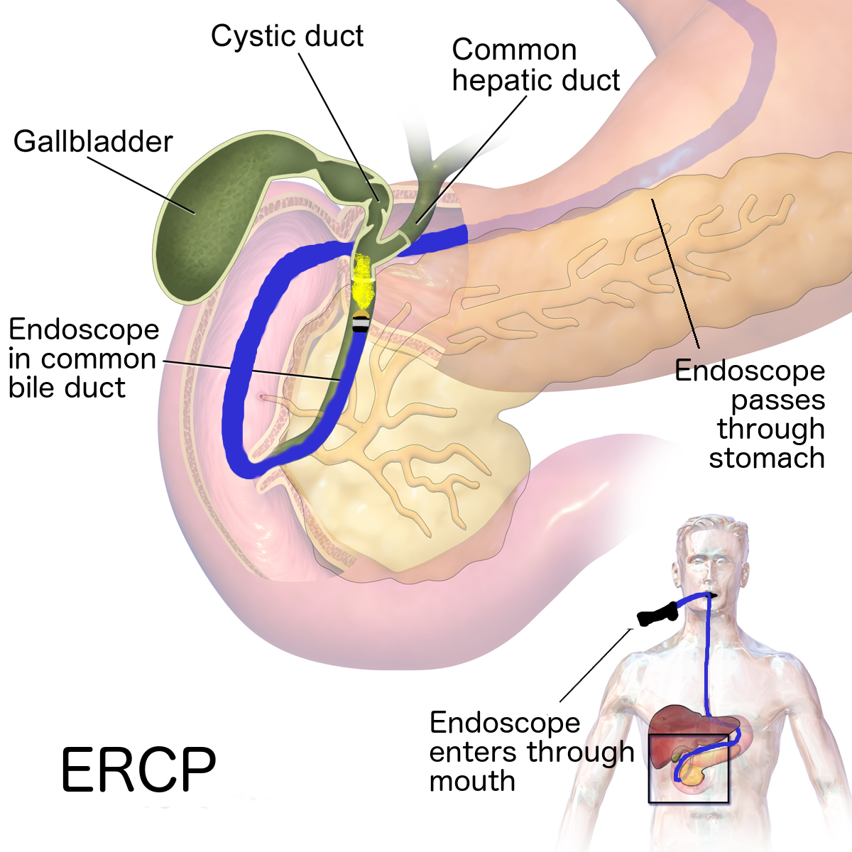 ercp stent