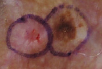 File:Malignant Melanoma right temple medial adjacent sebaceous hyperplasia right temple lateral.jpg