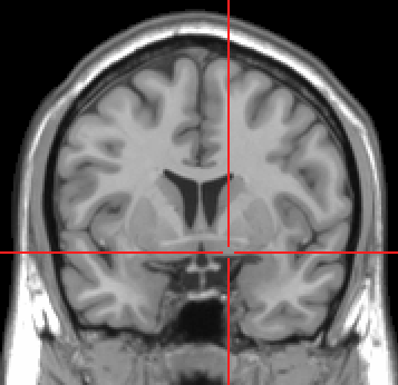 https://upload.wikimedia.org/wikipedia/commons/3/36/Substantia_innominata_MRI.PNG