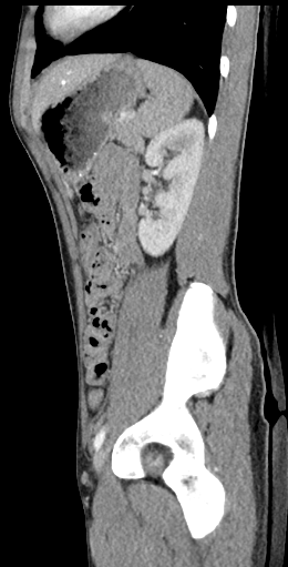 CT of a normal abdomen and pelvis, sagittal plane 122.png