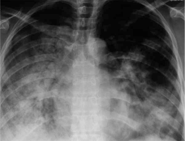 File:X-ray of 29-year-old person with H1N1.jpg