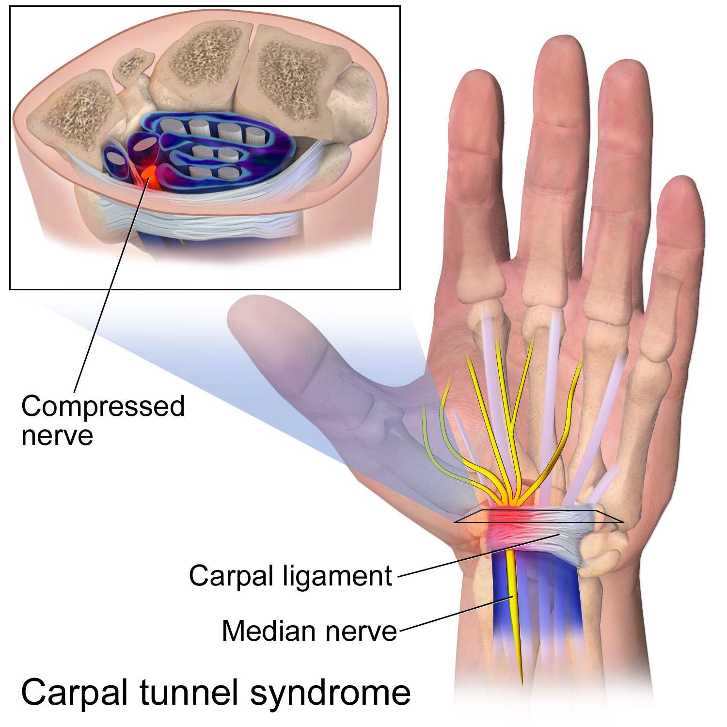 carpal tunnel surgery - wikipedia