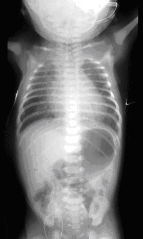 Plain X-ray of the chest and abdomen showing a feeding tube unable to move beyond an upper esophageal pouch.