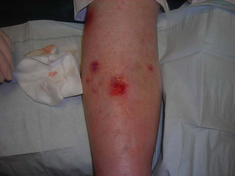 fibrinogen i vene varicoase varicoza pe injectarea picioarelor