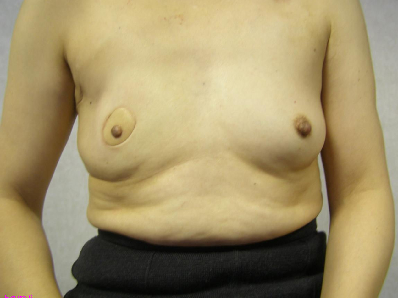 Breast reconstruction 18.jpg. 