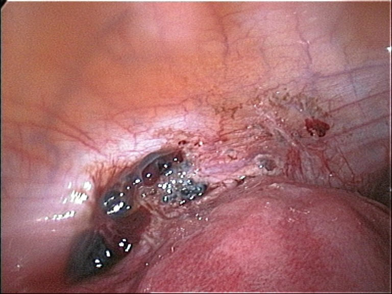 File:Endometriosis1.jpg