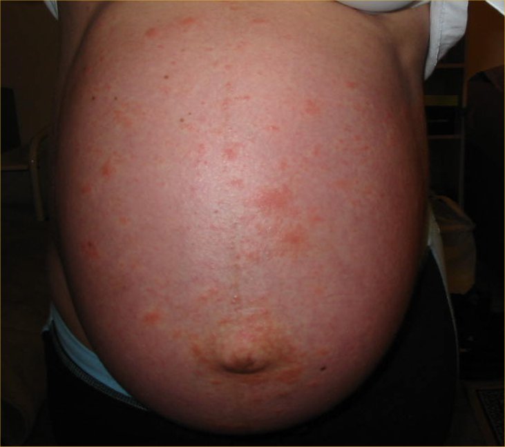 PUPPS rash - Pictures, Symptoms, Causes, Treatment