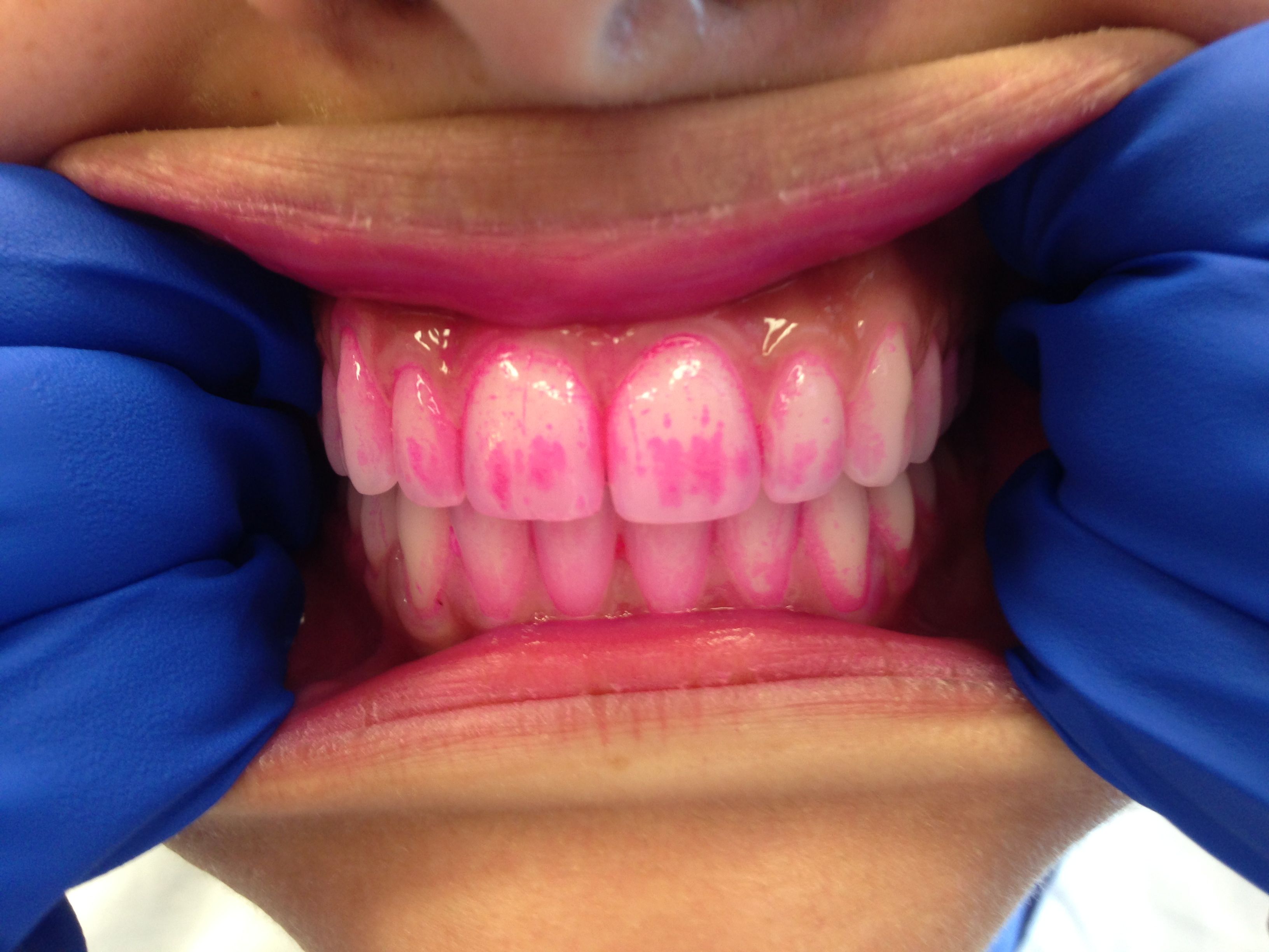 Multi-colour disclosing of dental plaque. Left: clinical image showing