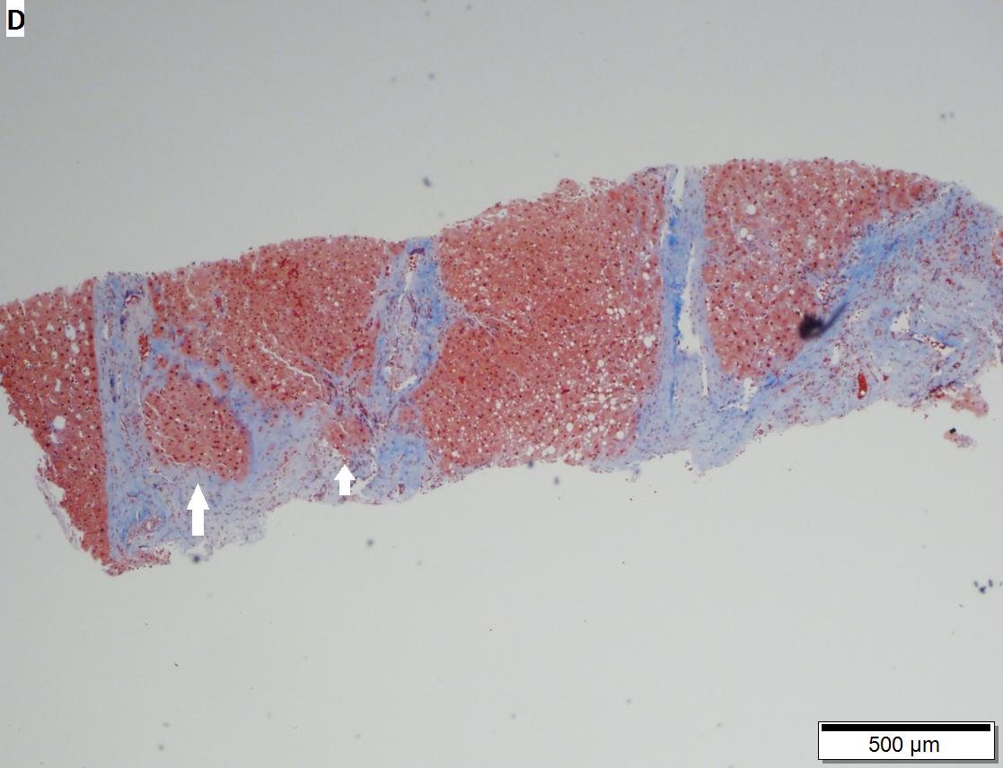 Cirrhosis with steatohepatitis in a 54 year old man