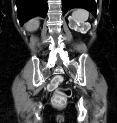 File:Hufeisenniere 04 - CT - coronar - 026.jpg