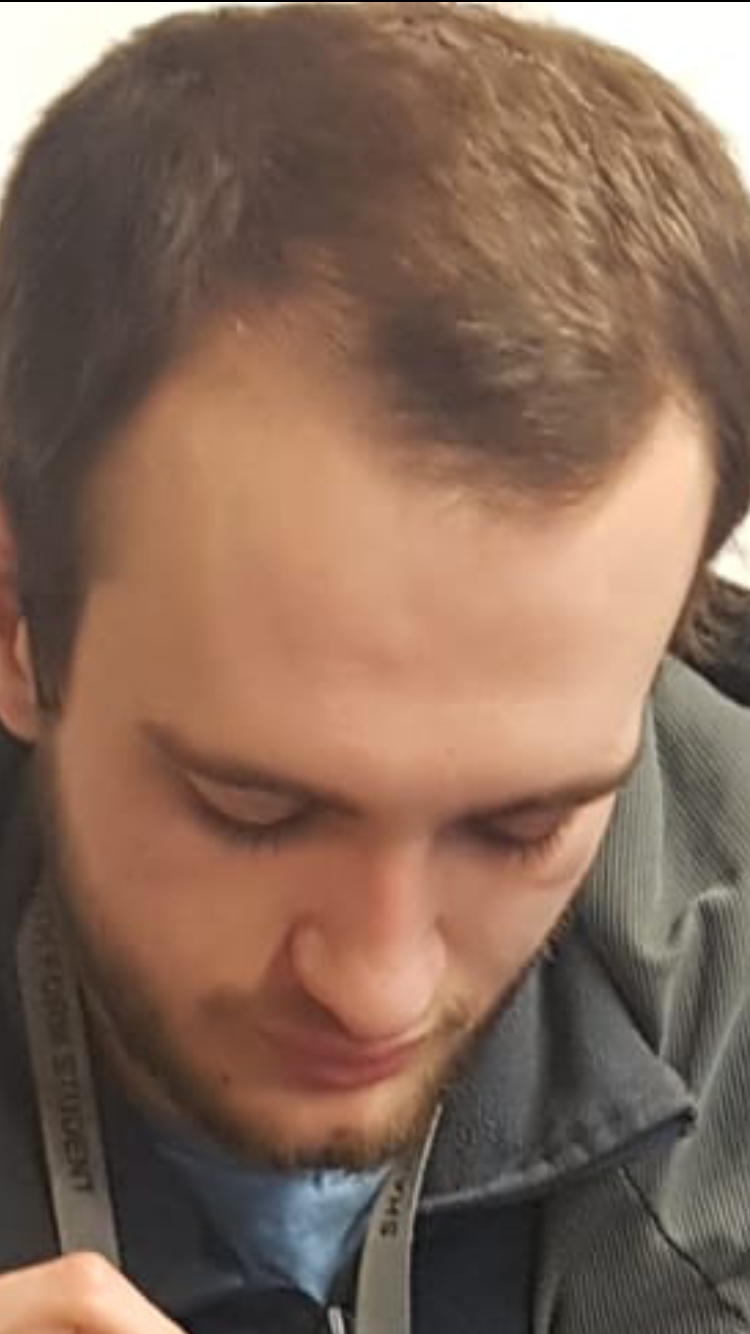 https://upload.wikimedia.org/wikipedia/commons/3/3a/Receding_Hairline.png