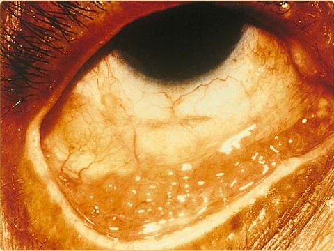 File:SOA-conjunctivitis.jpg