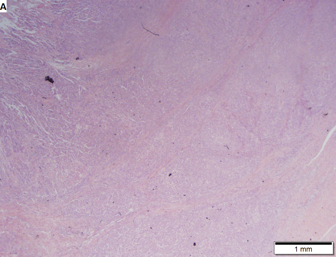 Medullary carcinoma of cecum.