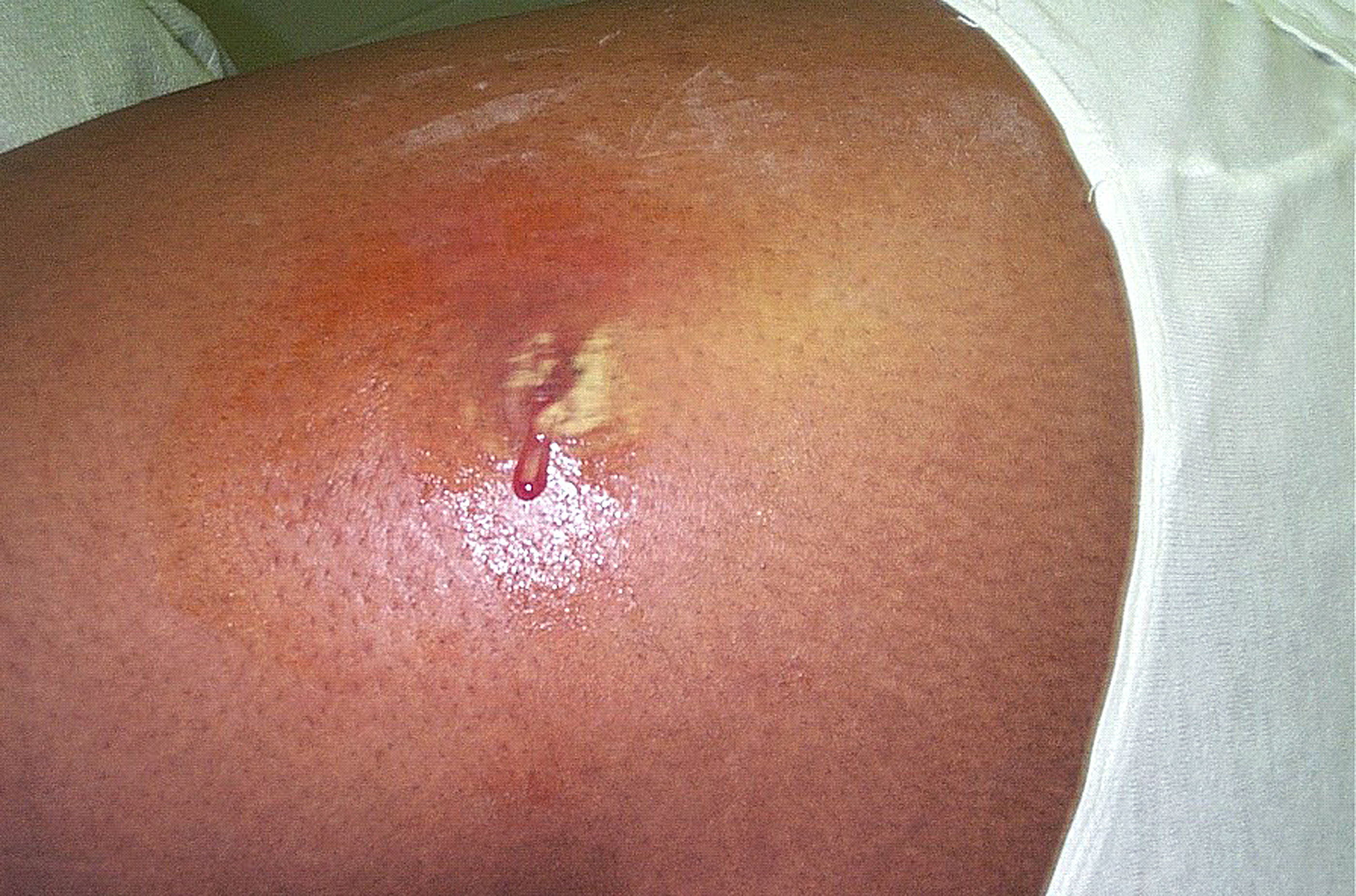 MRSA Infection abscess boil pimple popping pus on Armpit ...