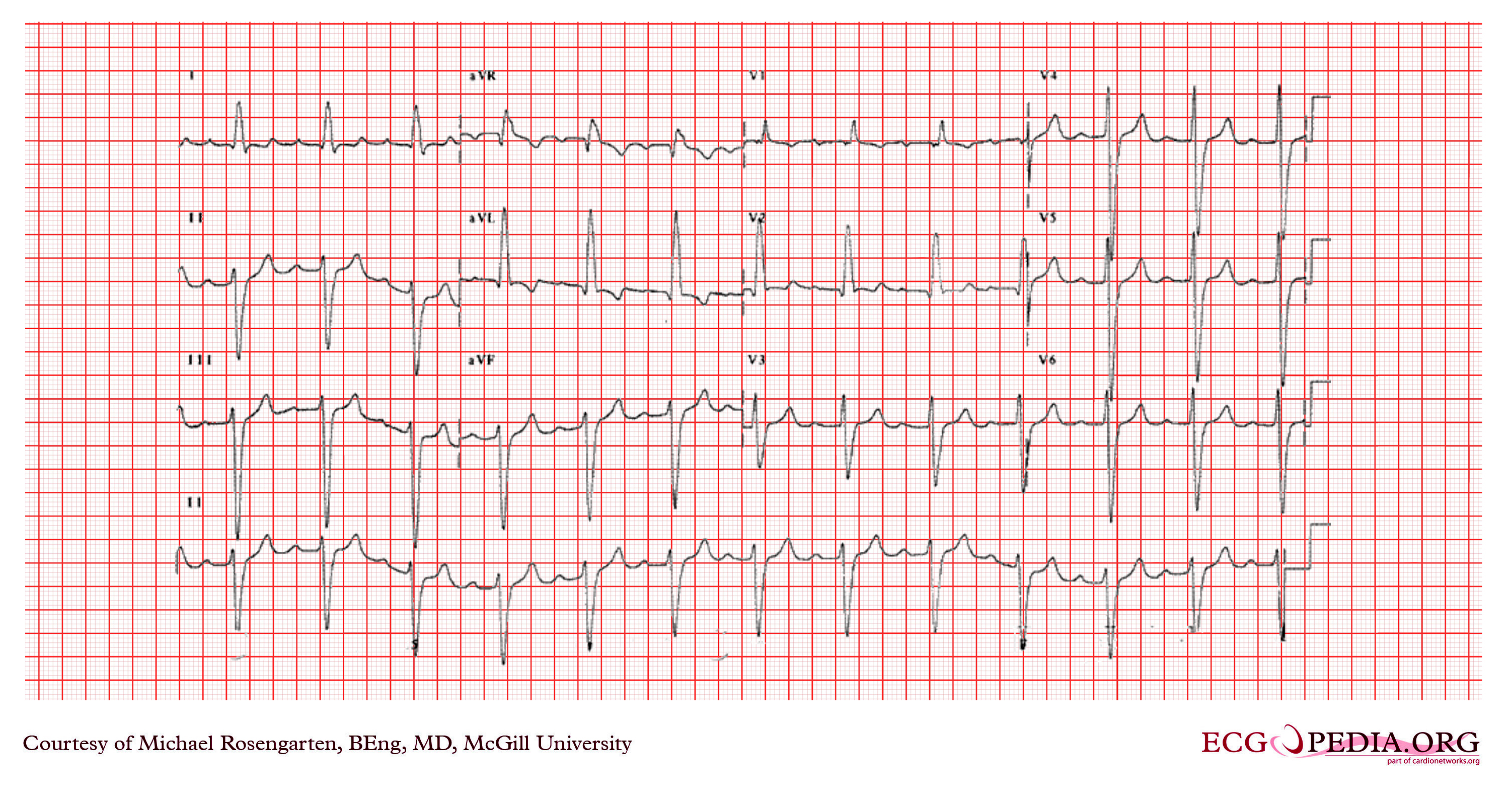 File:RBBB with first degree AV block.jpg - Wikipedia