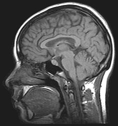 <span class="mw-page-title-main">Idiopathic intracranial hypertension</span> Medical condition