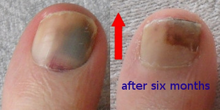 File:Onychomycosis (tinea unguium).jpg