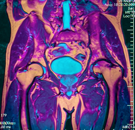 Pelvic MRI 125230 rgbca 61m diff stir t1