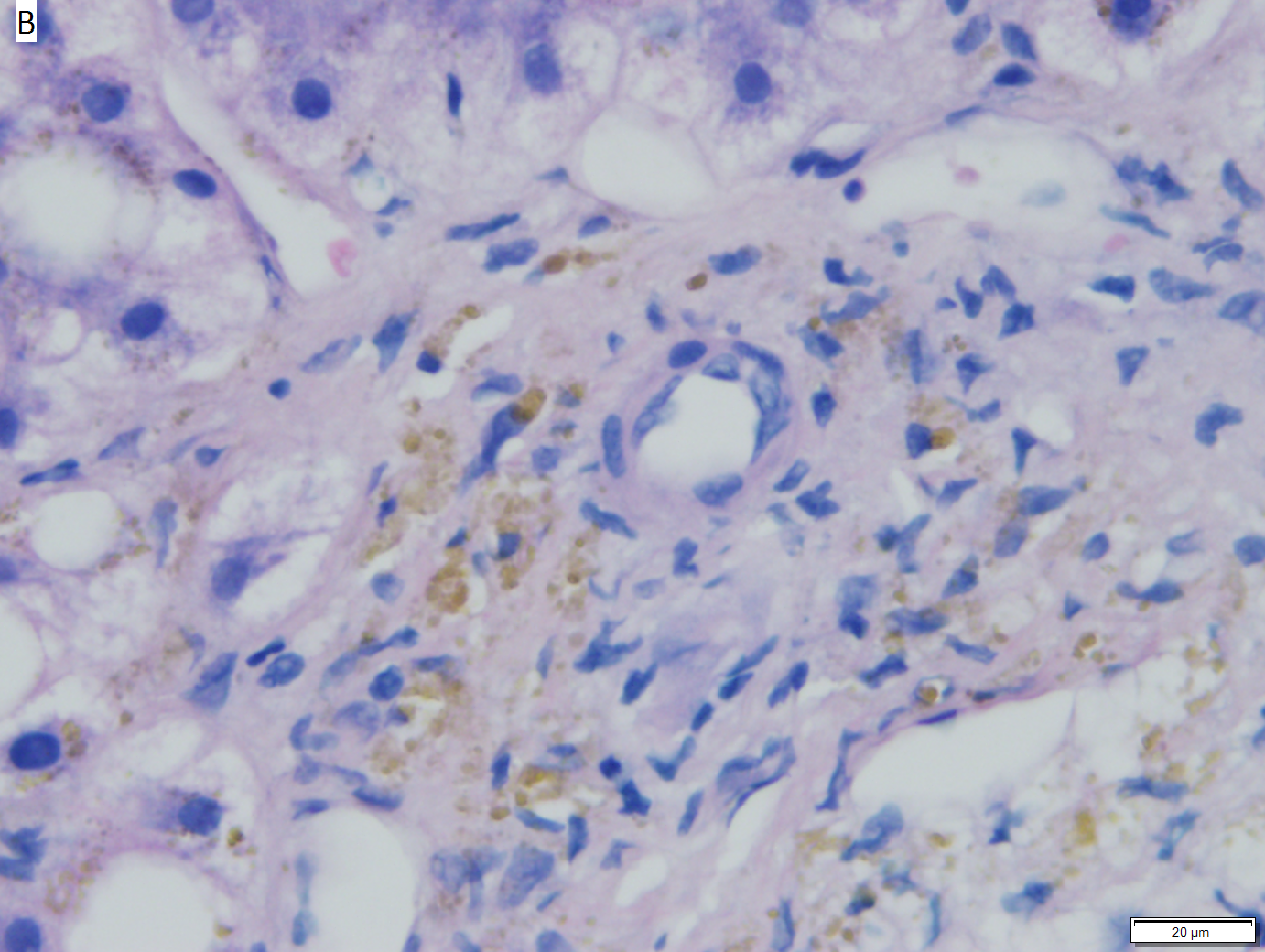 Hepatic graft versus host disease (L-GVHD)