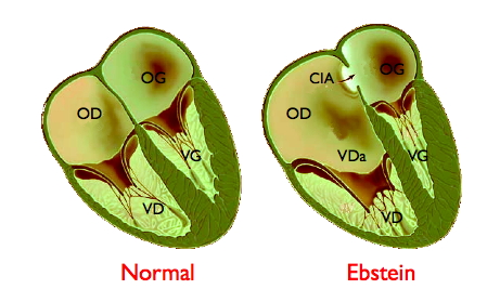 Mau posicionamento da válvula tricúspide na anomalia de Ebstein