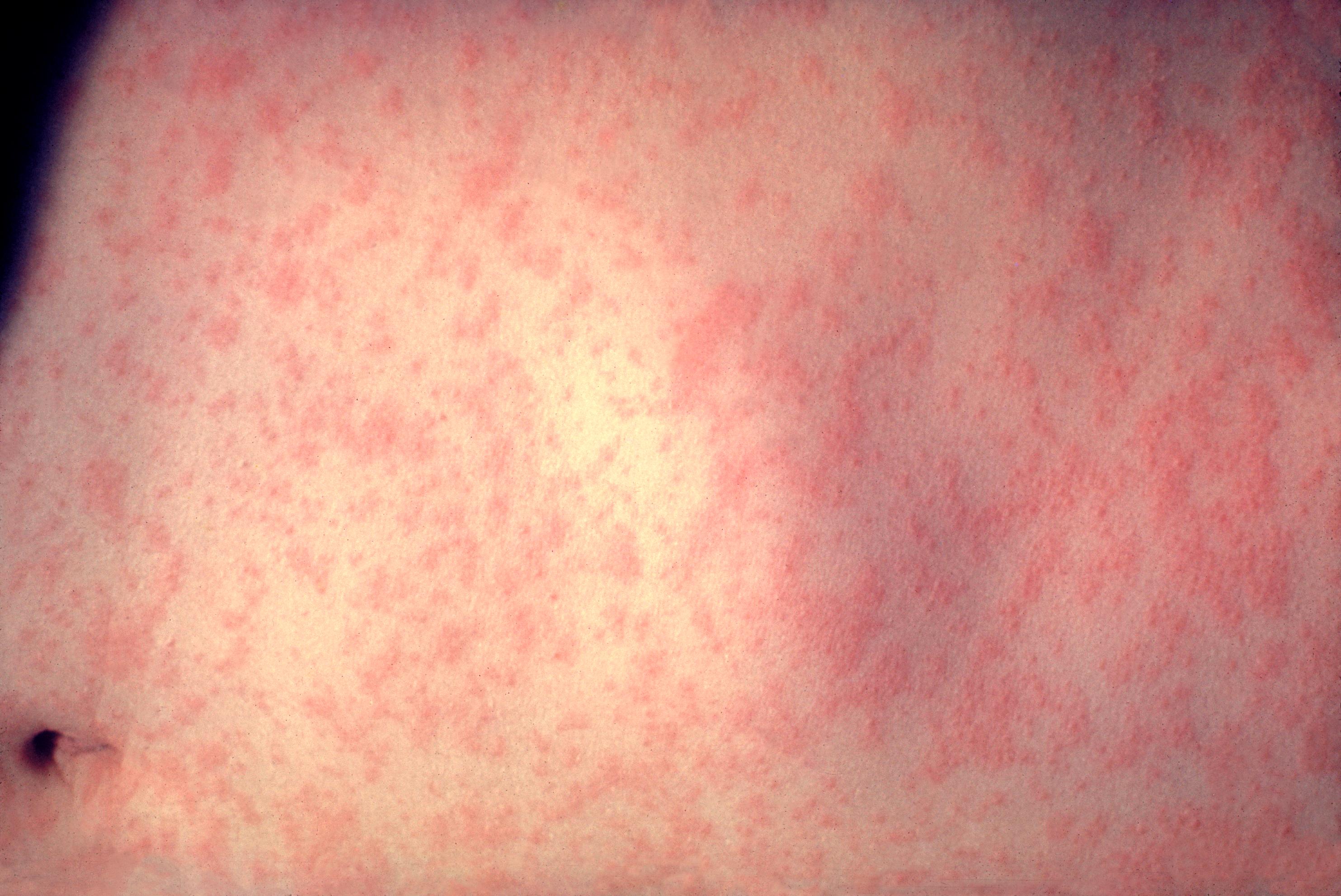 File Morbillivirus Measles Infection jpg Wikipedia