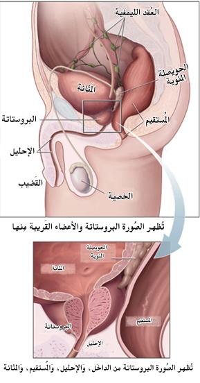 سرطان البروستاتا Wikiwand