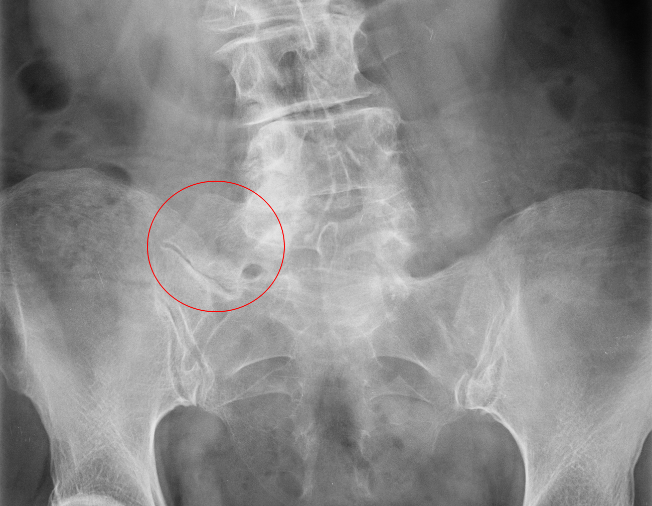 Injury of the Iliac Crest Apophysis, Radiology Case