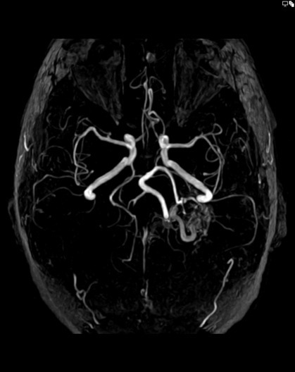 File:001-Arteriovenous-malformation-TOF-MIP-13.jpg