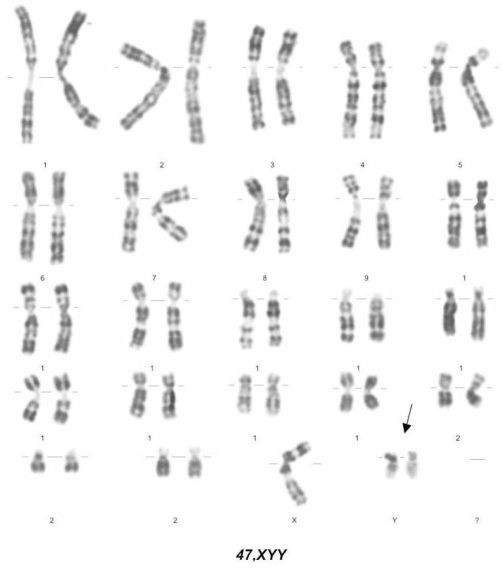 Появление дополнительной хромосомы. XYY кариограмма. Кариотип 47 хуу синдром. Синдром Клайнфельтера кариотип.