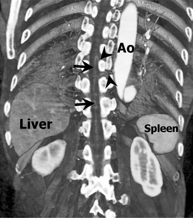 artery of adamkiewicz diagram