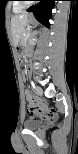 CT of a normal abdomen and pelvis, sagittal plane 103.png