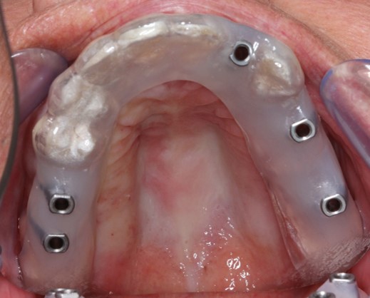 File:Implantat-Bohrschablone.jpg