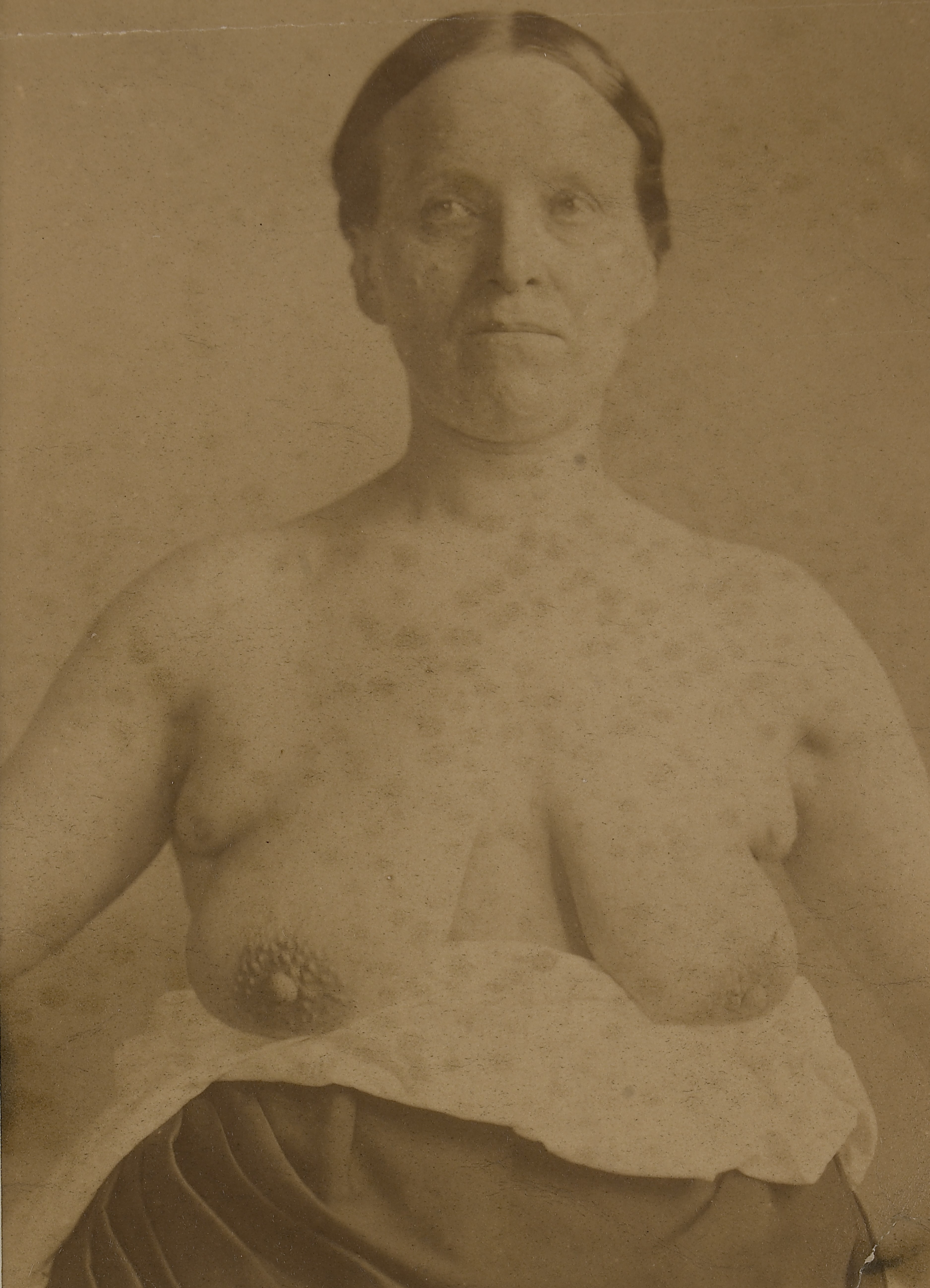 File:Woman with supernumery breasts and nipples Wellcome L0062997