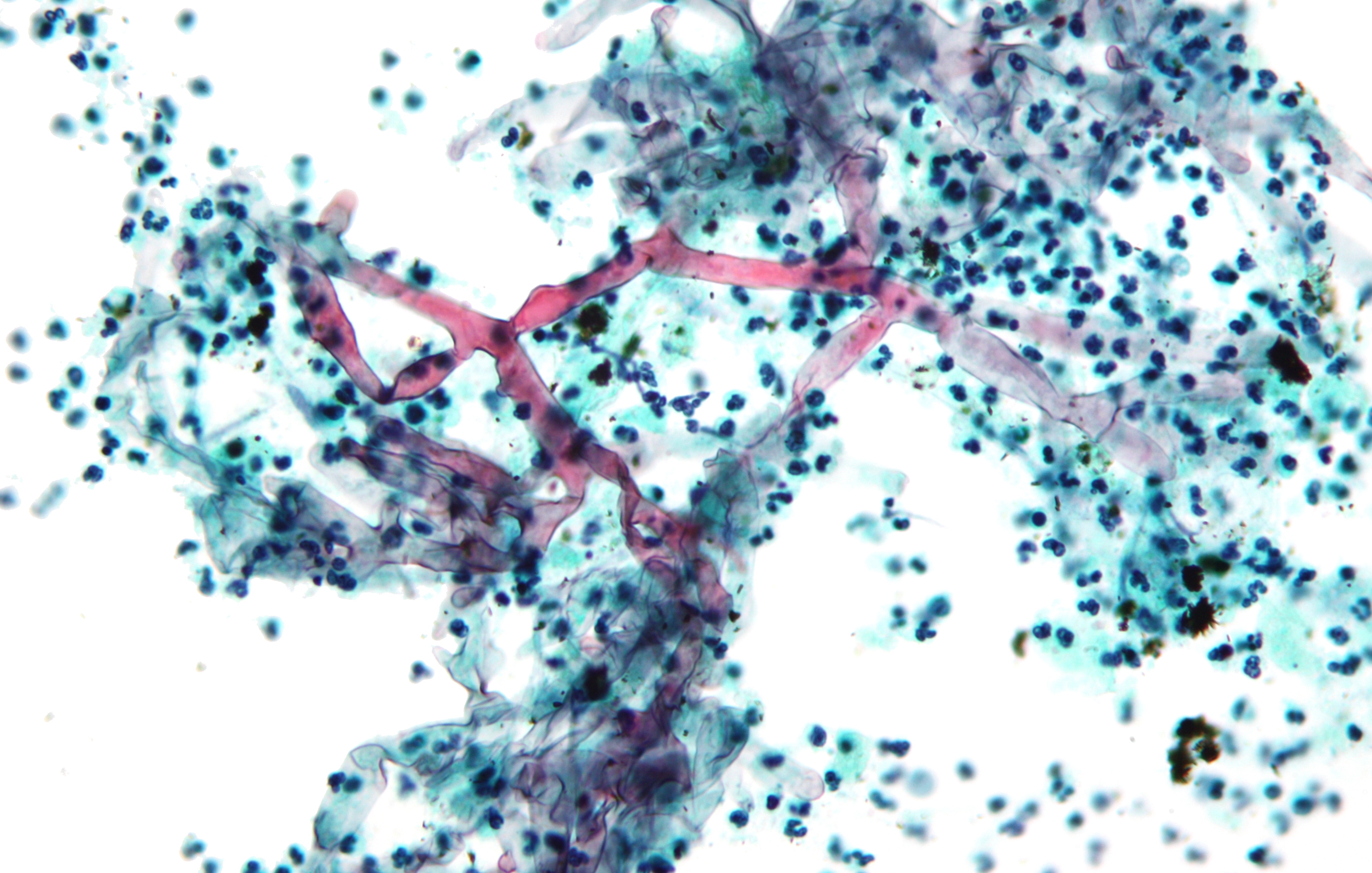 Mucormycosis Under a Microscope