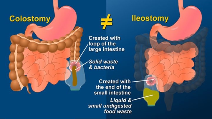 File:Bowel Ostomies.jpg