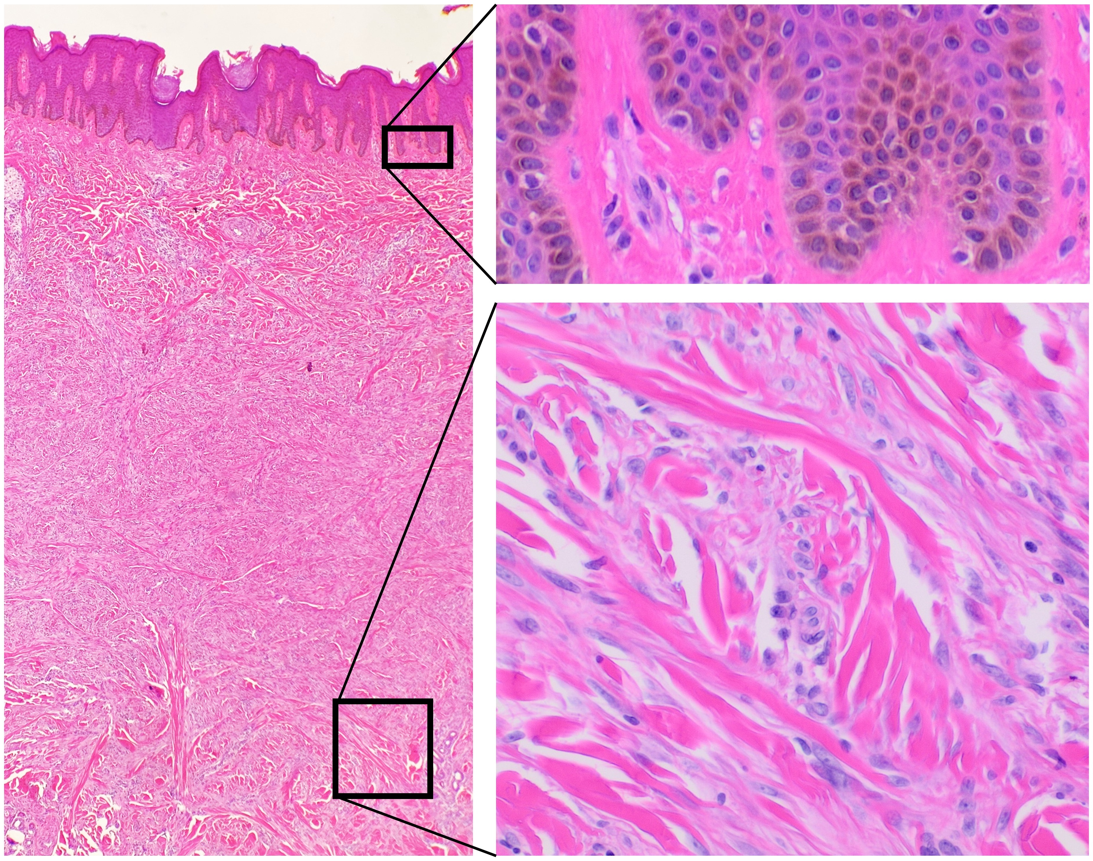 keloid histology