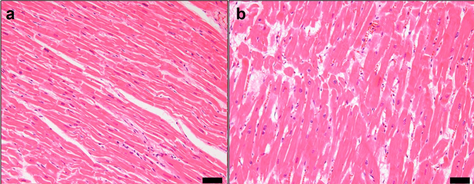 hypertrophy of the heart