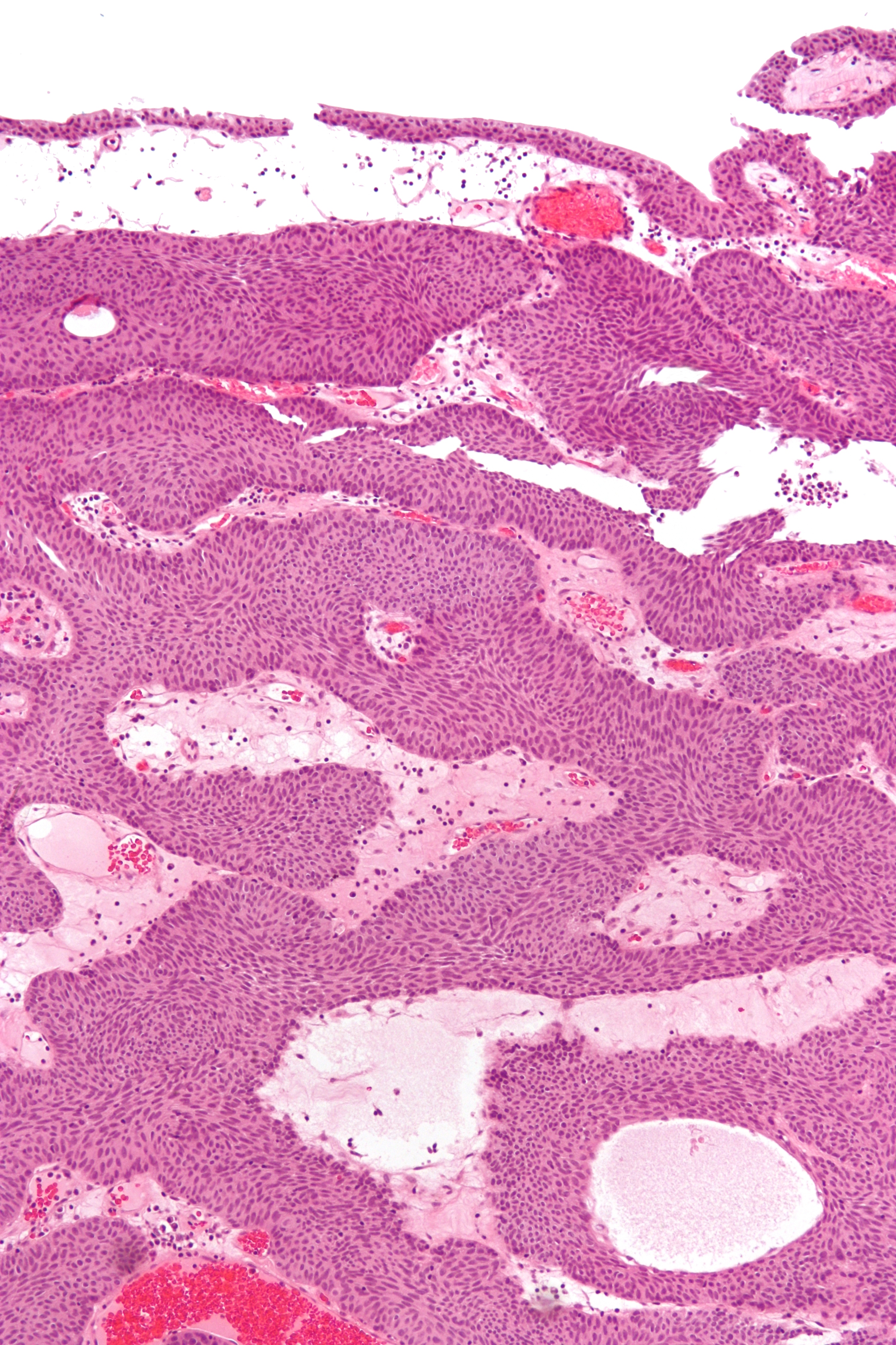 Sinonasal papilloma pathology outlines Romanian Journal of Urology - PDF Free Download