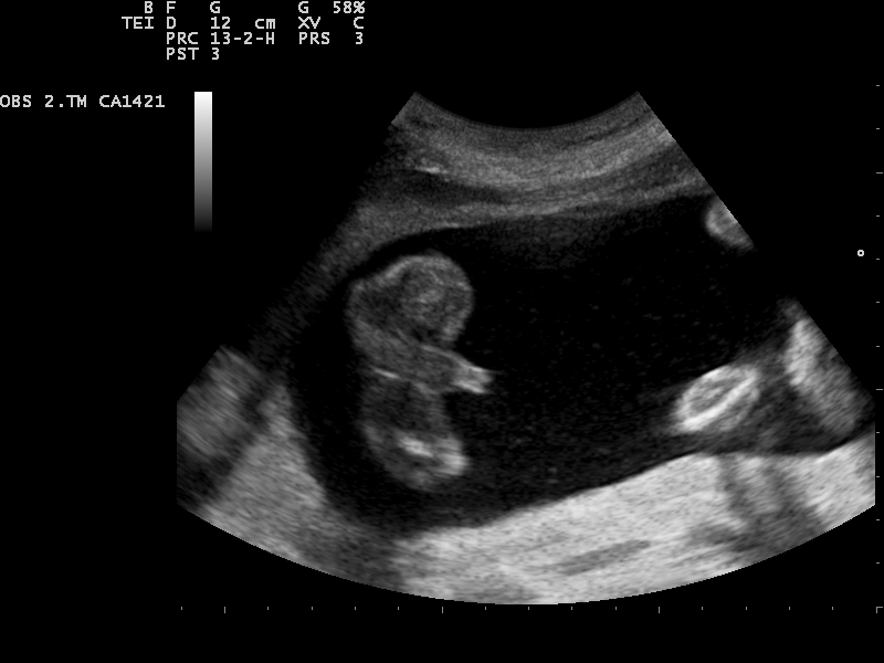 File:Ultrasound Scan ND 1230131341 1323100.png