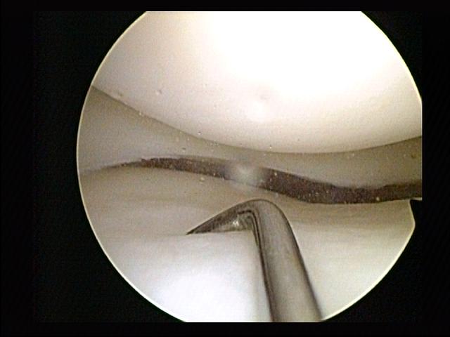 File:Lateral meniscus chondromalacia.jpg