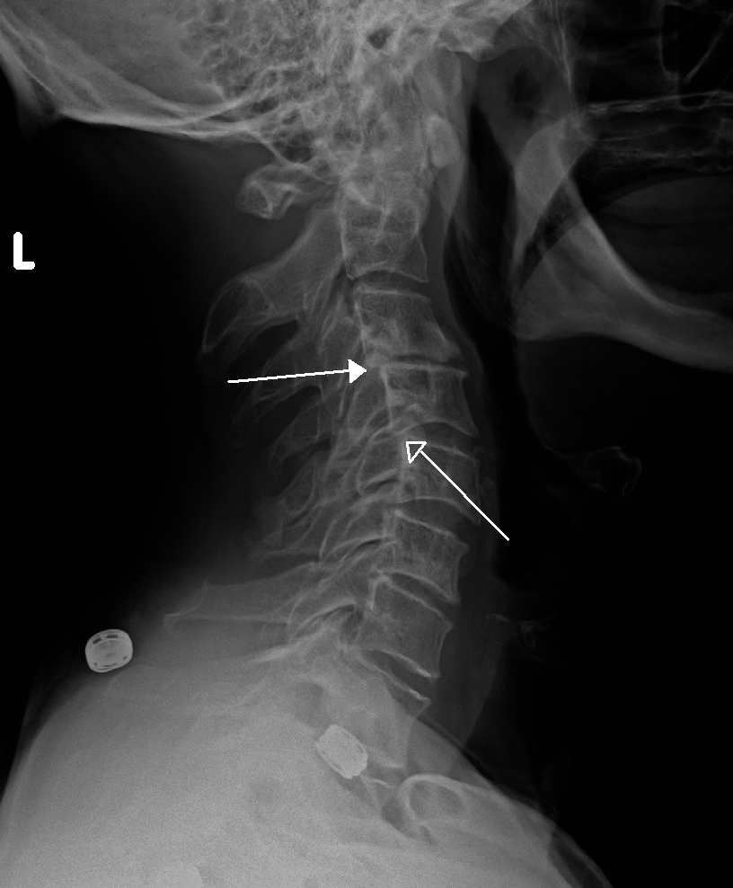 Grade 1 retrolisthesis l5