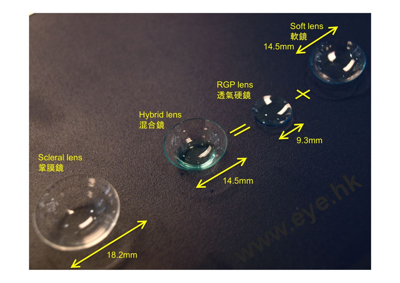 keratoconus contact lenses