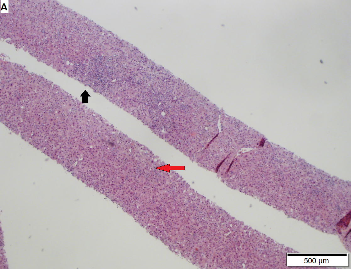 Acute hepatitis C