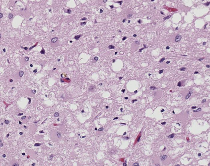 File:Variant Creutzfeldt-Jakob disease (vCJD), H&E.jpg