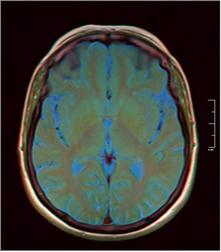 File:Brain MRI 0153 10.jpg