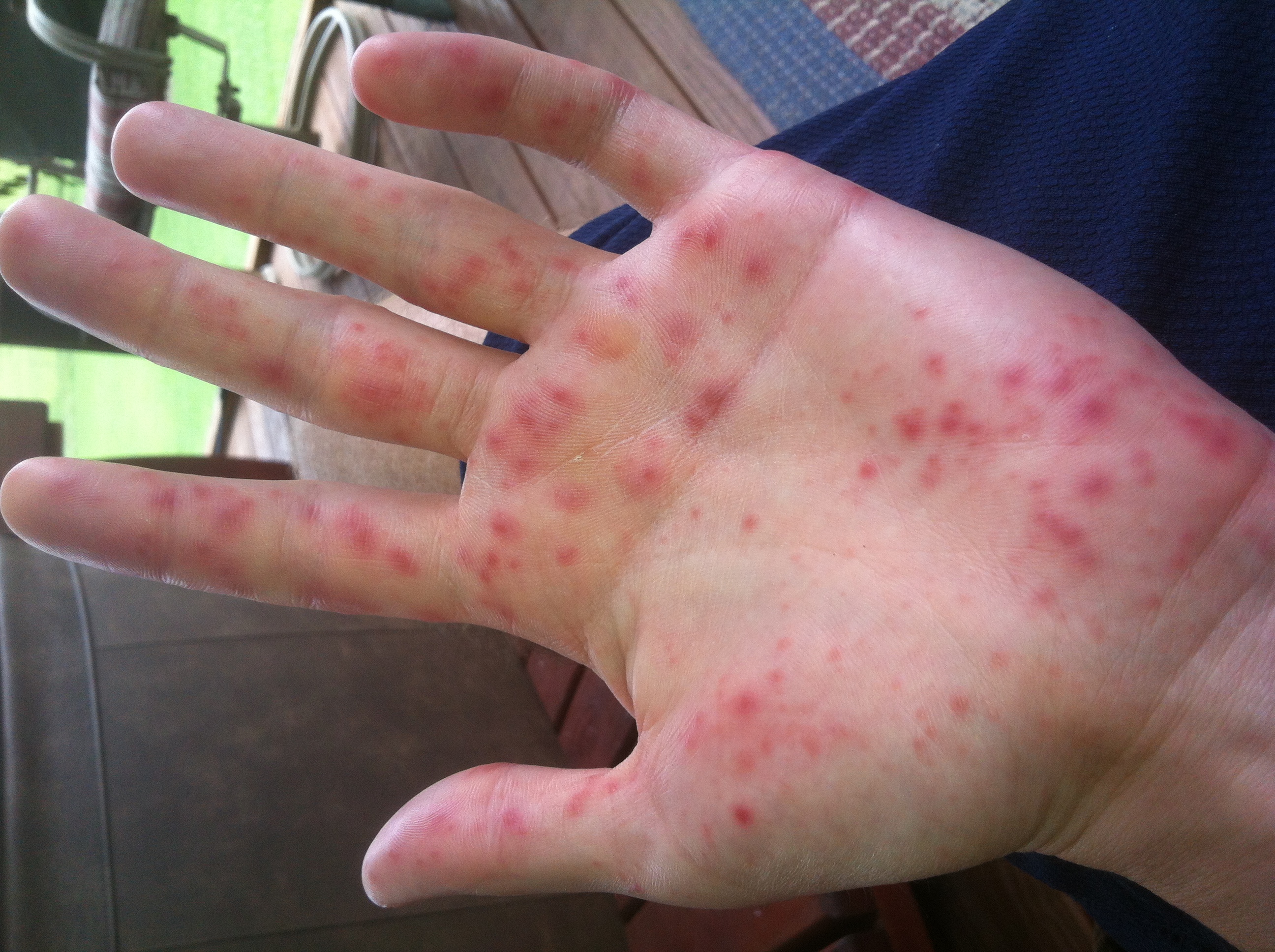 hand foot mouth disease images