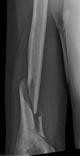 <span class="mw-page-title-main">Holstein–Lewis fracture</span> Medical condition