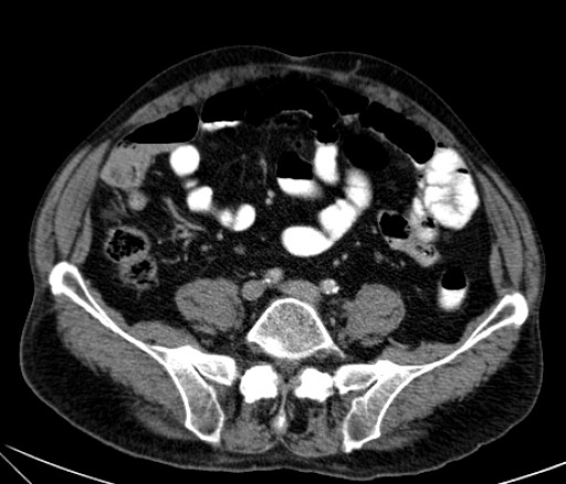 File:Hufeisenniere 03 - CT - axial - 040.jpg