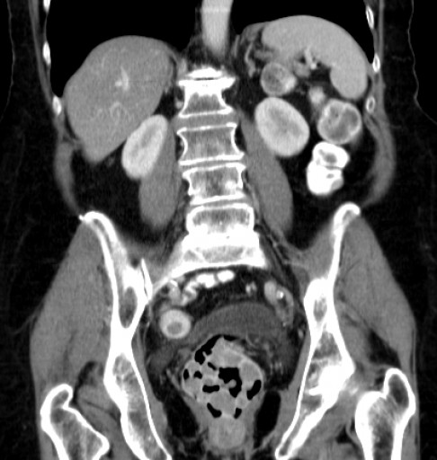 File:Hufeisenniere 04 - CT - coronar - 021.jpg